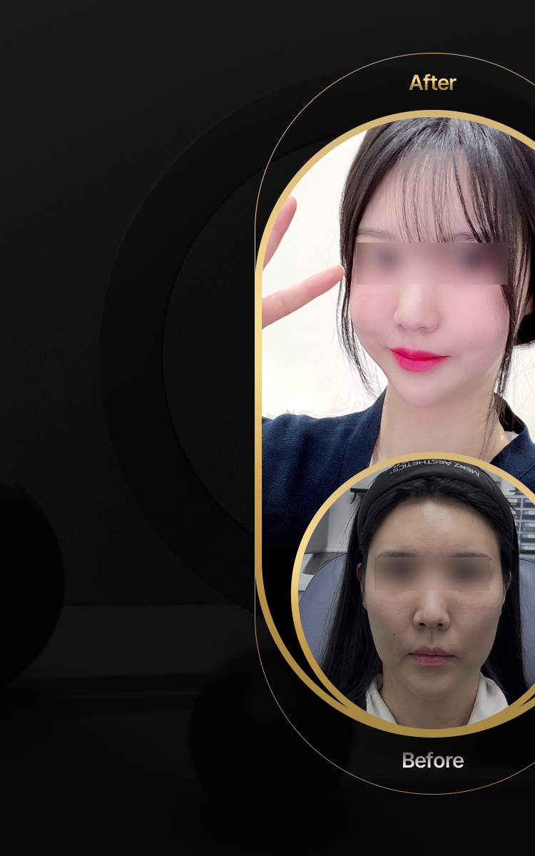 압구정 피부과 강남 피부과 튠클리닉 볼패임 리프팅 비주얼 모델