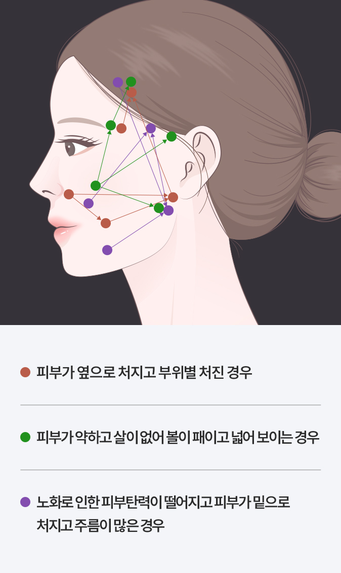 강남 압구정 리프팅 튠클리닉 20년 노하우 실리프팅 테크닉