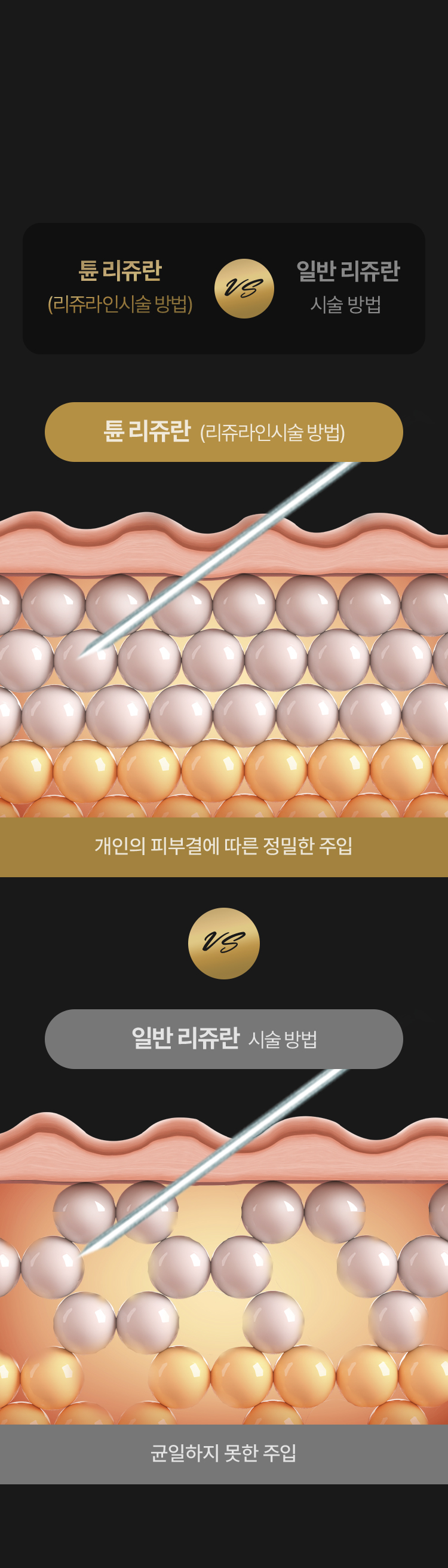 압구정 피부관리 강남 피부과 튠클리닉 리쥬란 시술방법 이미지