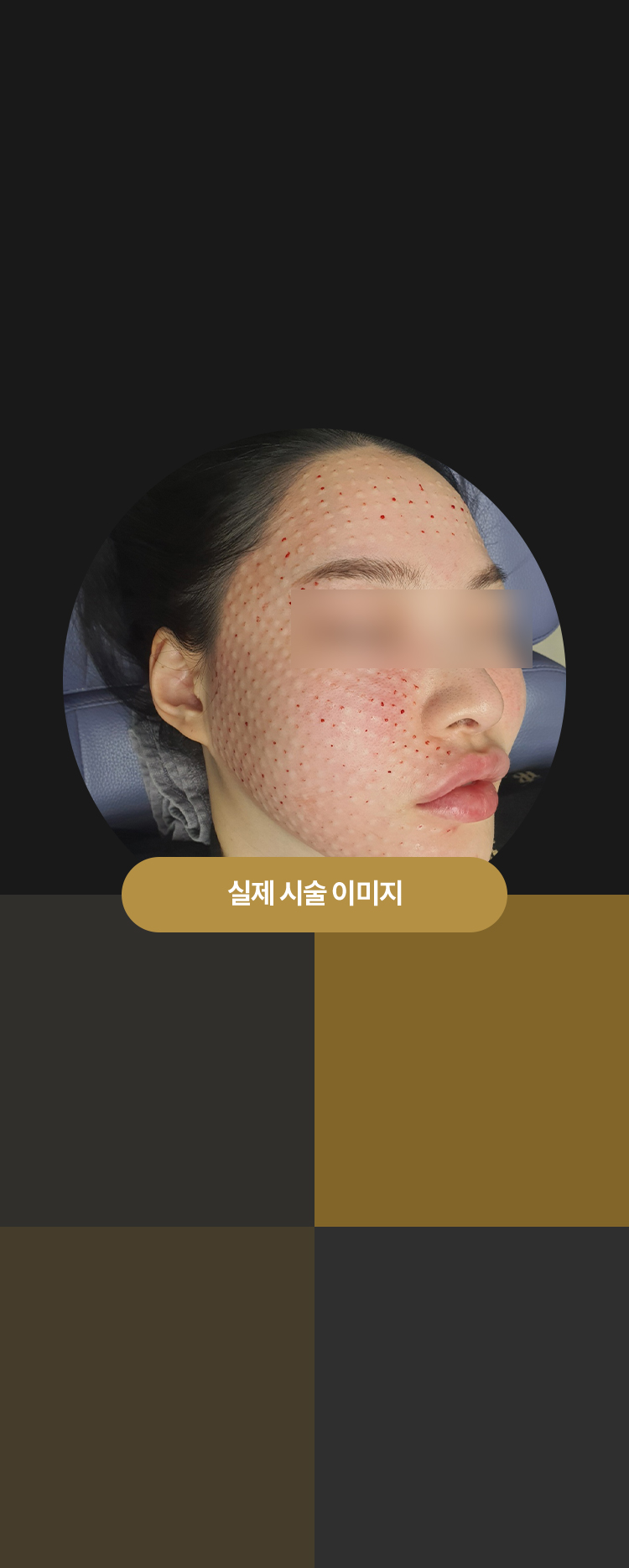 압구정 피부과 강남 피부관리 튠클리닉 리쥬란 실제시술 이미지