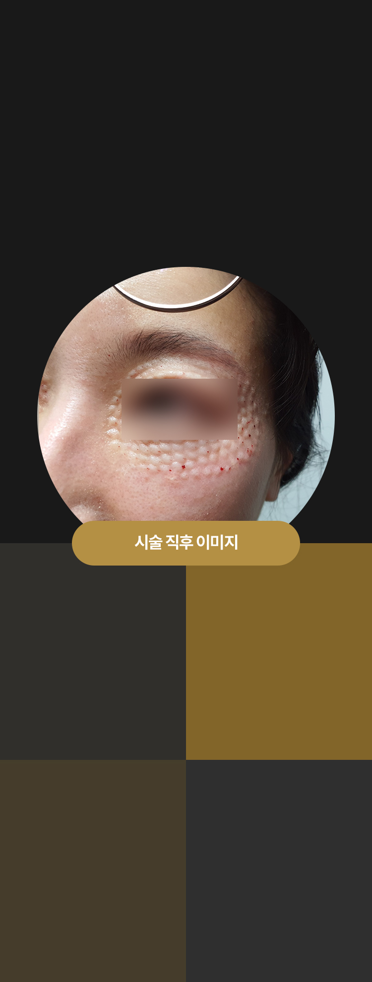 강남 피부과 압구정 리프팅 튠클리닉 리쥬란 정밀주입 테크닉